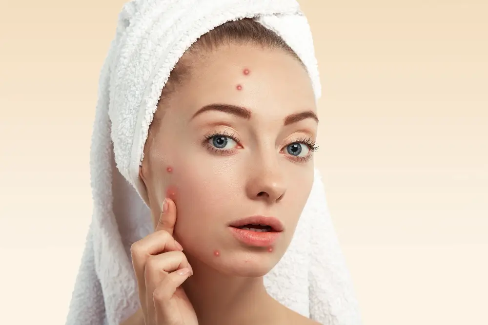 Acne Management In El Dorado Hills