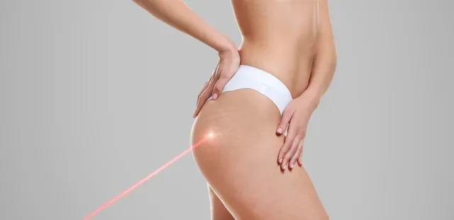 Stretch Marks and Scar Reduction Treatment El Dorado Hills